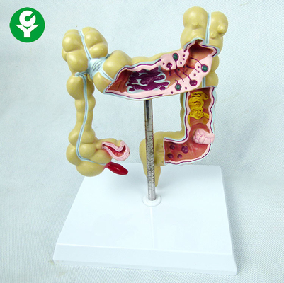 Diseased Educational Body Parts Models / Large Gastrointestinal Model