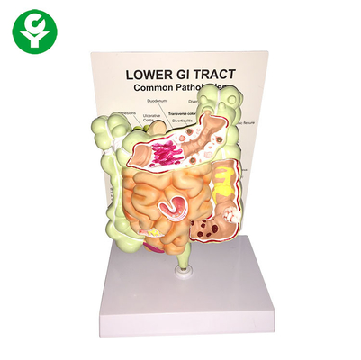 Lower Gi Tract Common Pathology Model 20X15X16 Cm Single Package Size
