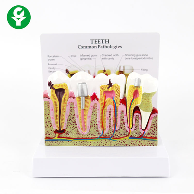 Periodontal Dental Teeth Model Human Medical Decay Common Pathologies Display
